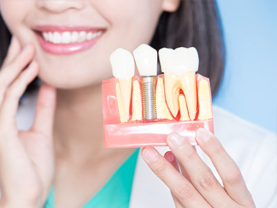 A woman with a smiling expression holds up a transparent model of a mouth with teeth being drilled, showcasing dental implant tools and the process of implant surgery.