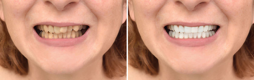 The image shows a person with a wide smile, displaying two rows of teeth, against a blurred background.