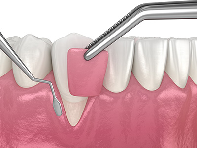 Monica Rao, DMD | Single Tooth Implant, Implant Retained Bridge and Dentures
