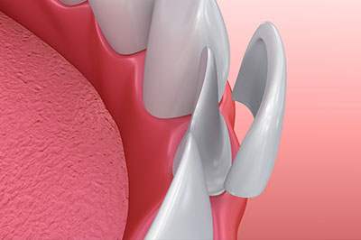 Monica Rao, DMD | Dental Bridges, Scaling   Root Planing and Preventative Program