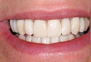 The image shows a close-up of a person s smiling mouth with white teeth, displaying a healthy dental appearance.