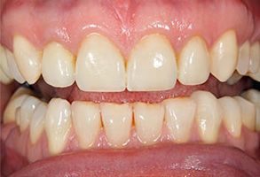 The image shows a close-up view of a person s teeth with visible yellowing, indicating possible dental issues or staining.