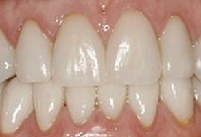The image shows a person s teeth with a focus on dental hygiene, likely intended for educational or informational purposes.