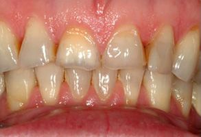 The image shows a close-up view of an individual s teeth with some yellowing and staining, which are common signs of dental wear or neglect.